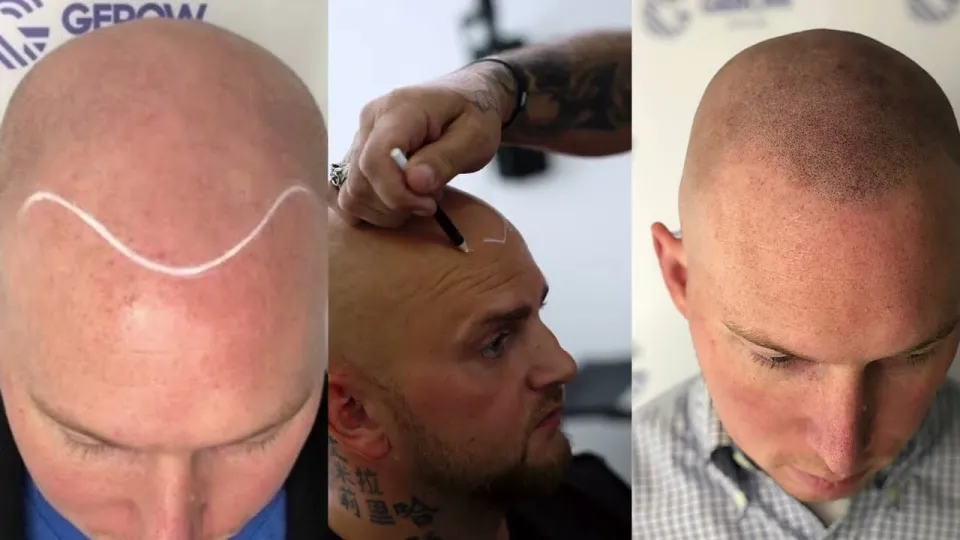 Best hairloss solution in NYC offers effective non-invasive scalp micropigmentation results